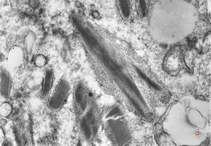 bone marrow - crystalloid inclusions Charcot-Leyden crystals formation bone marrow - crystalloid inclusions Charcot-Leyden crystals formation